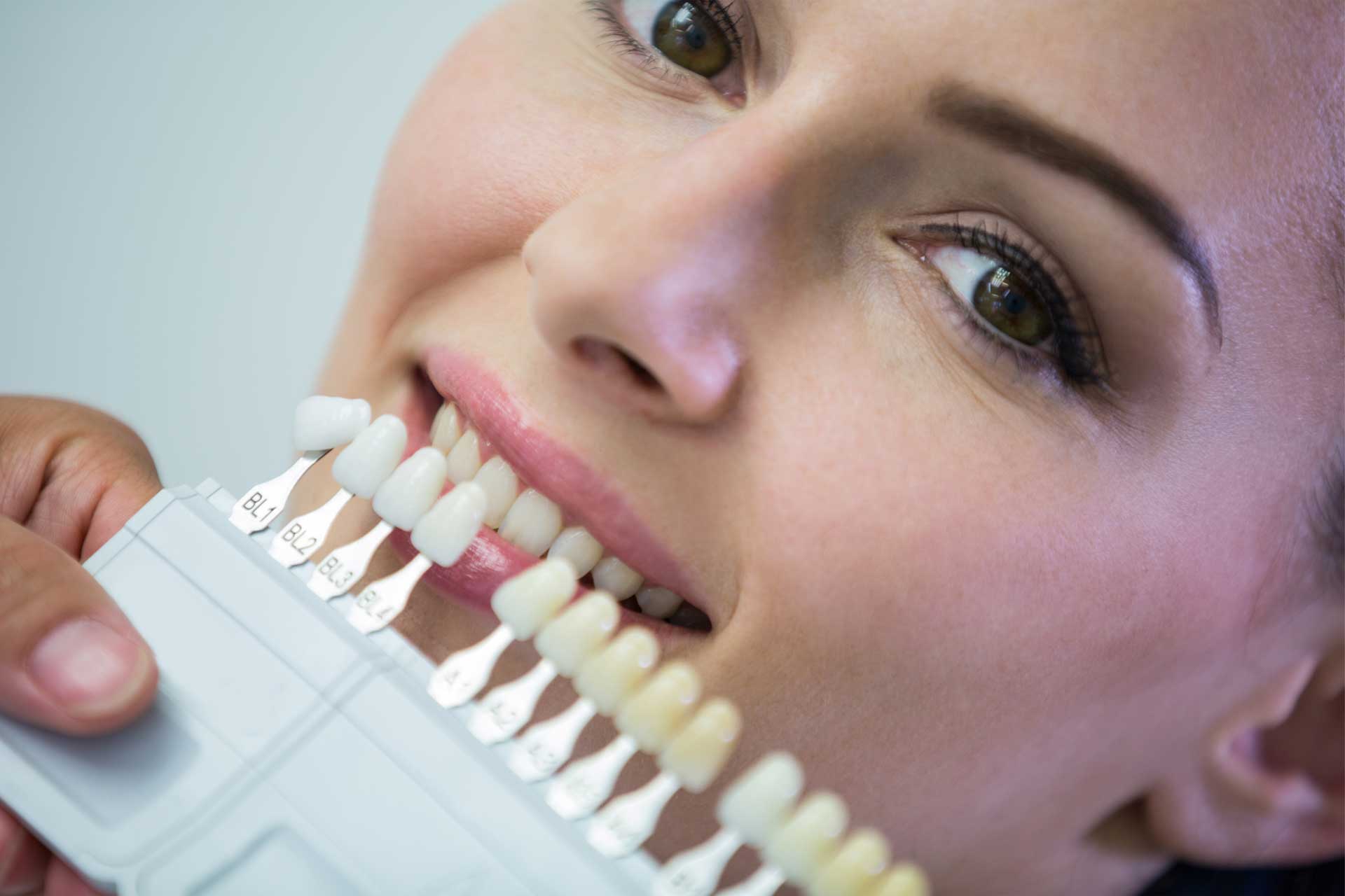 ceramic-veneers